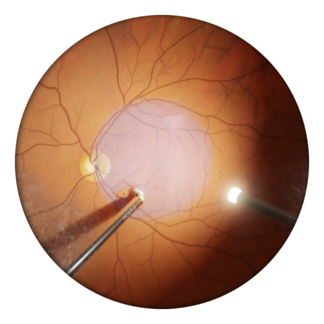 Eyesi Surgical - Retina surgery